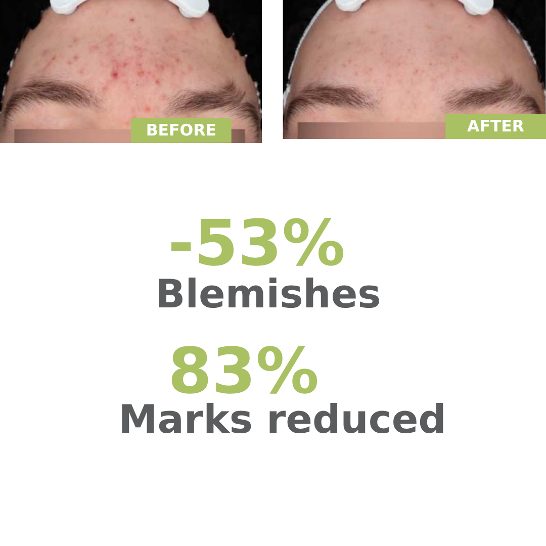 A-derma Biology AC Night Peel Anti-Blemish Serum